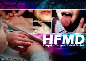 HFMD: Jangkitan naik 15 kali ganda, catat 31,661 kes setakat Mei