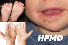 HFMD cases rise 28 times compared to last year — Deputy Minister