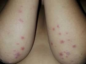 HFMD cases expected to decline in two to three weeks — KJ