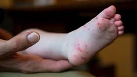 JKNS: 6,748 HFMD cases recorded in Selangor as of May 7