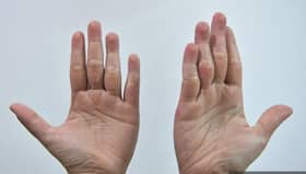 HFMD infections in Selangor under control