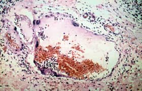 No Nipah cases detected after epidemic ended in 1999