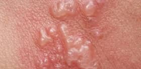 Pakar: Kayap lebih sakit dari bersalin, boleh sebabkan buta