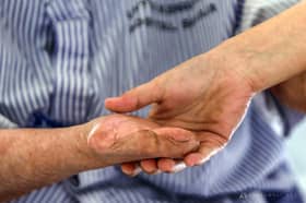 Kes kusta di Kelantan meningkat, 16 kes direkod sejak 2023