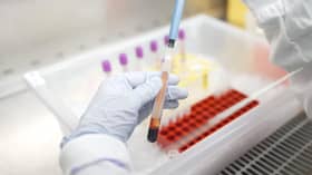 Australia bangunkan ujian darah berasaskan AI kesan awal barah payudara