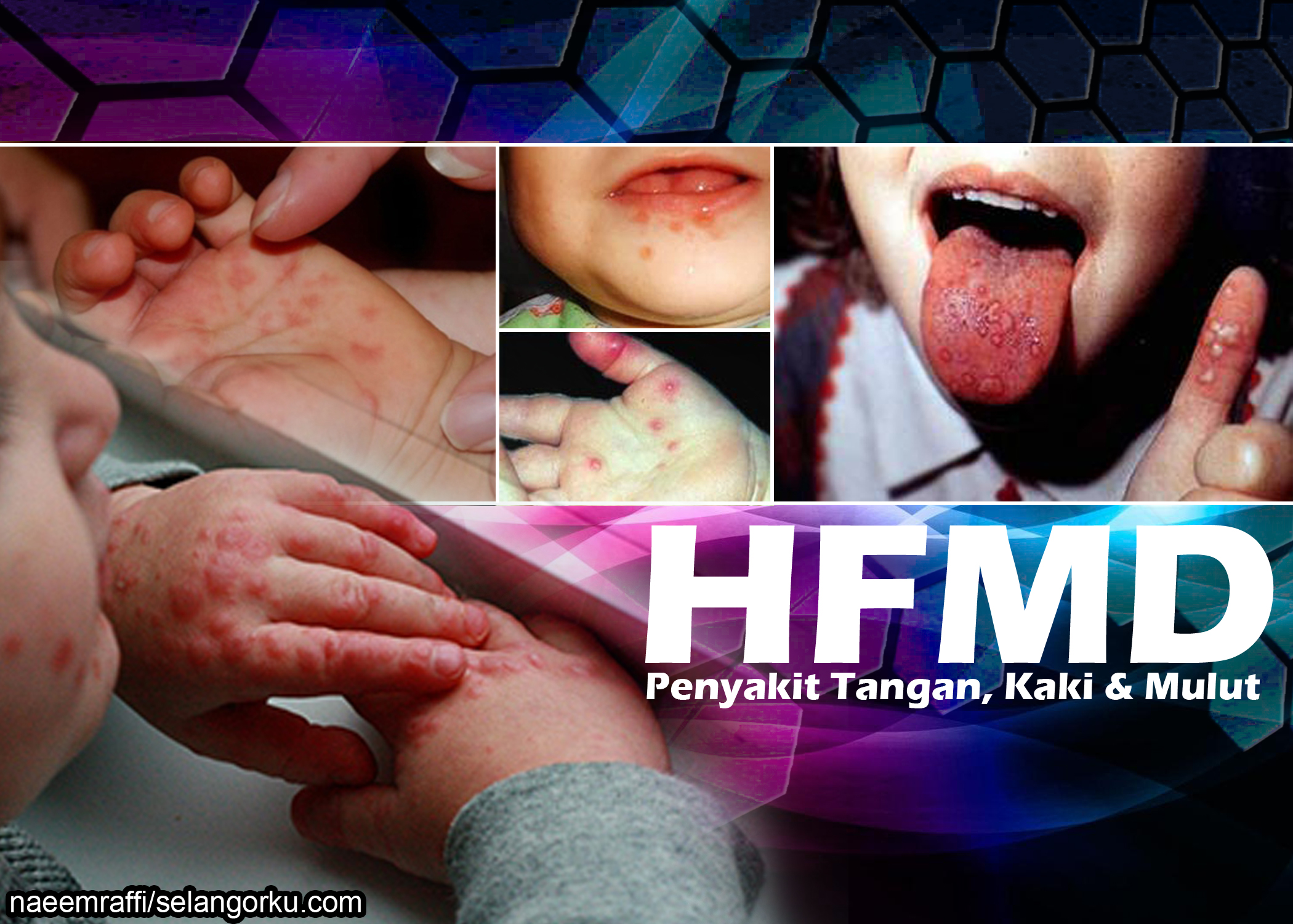 HFMD: Ibu bapa digesa tingkat kawalan kebersihan