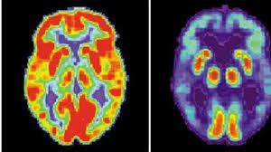 SPECIFIC GUIDELINES FOR BRAIN DEATH CASES