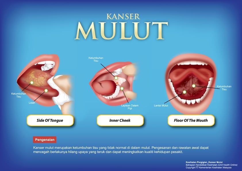 Tingkat kesedaran kesan awal barah mulut, 60 peratus tahap tiga, empat