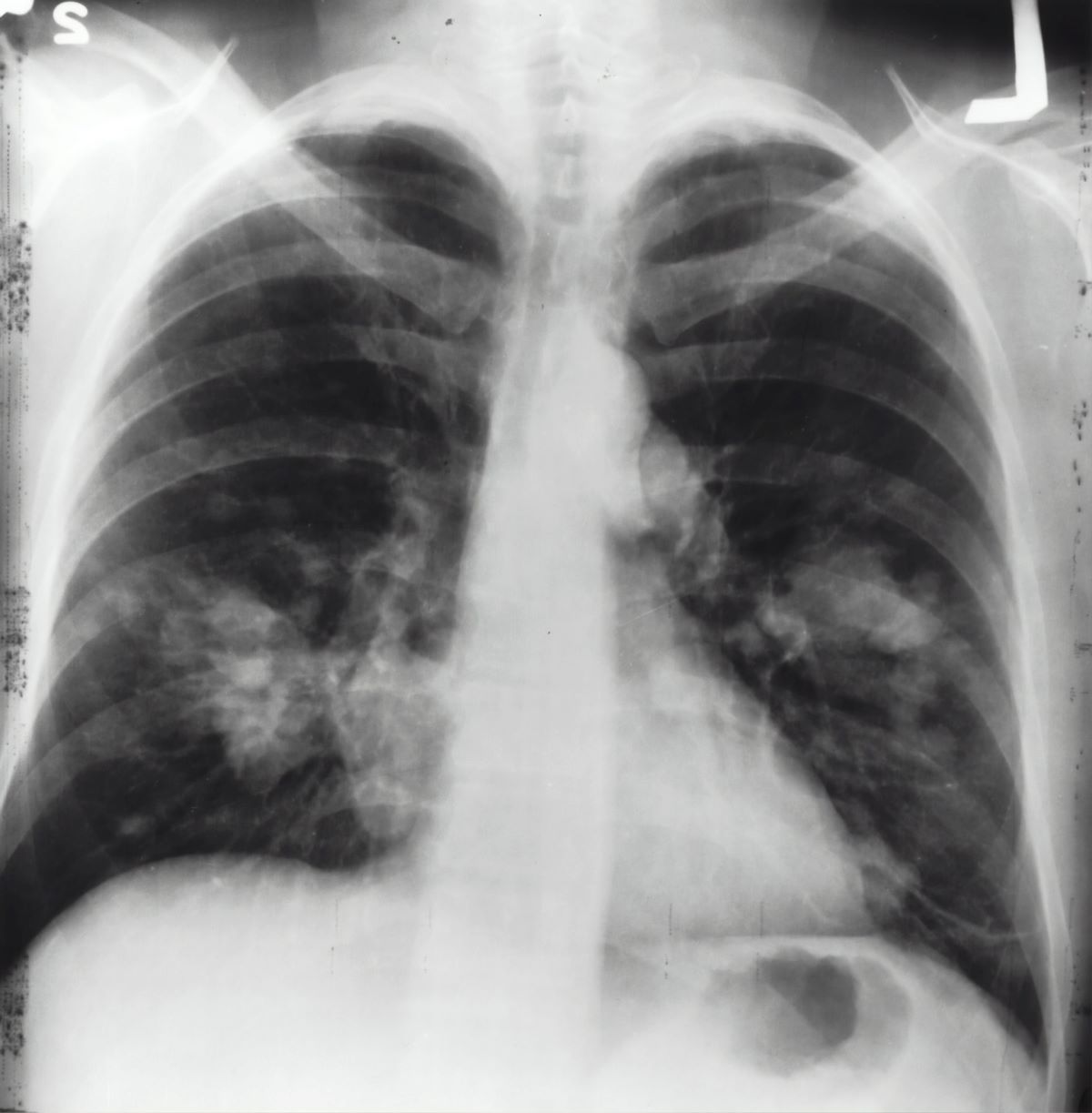 Tobacco use among causes of death due to cancer