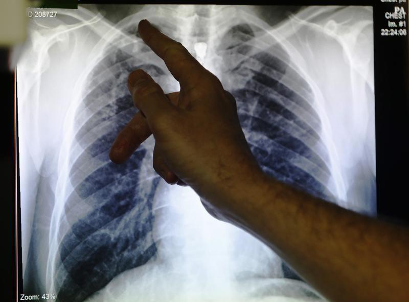 Tuberculosis deaths rose during Covid-19 pandemic, reversing years of decline — WHO