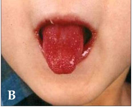 Experts warn parents to not underestimate Kawasaki Syndrome as potentially fatal to children