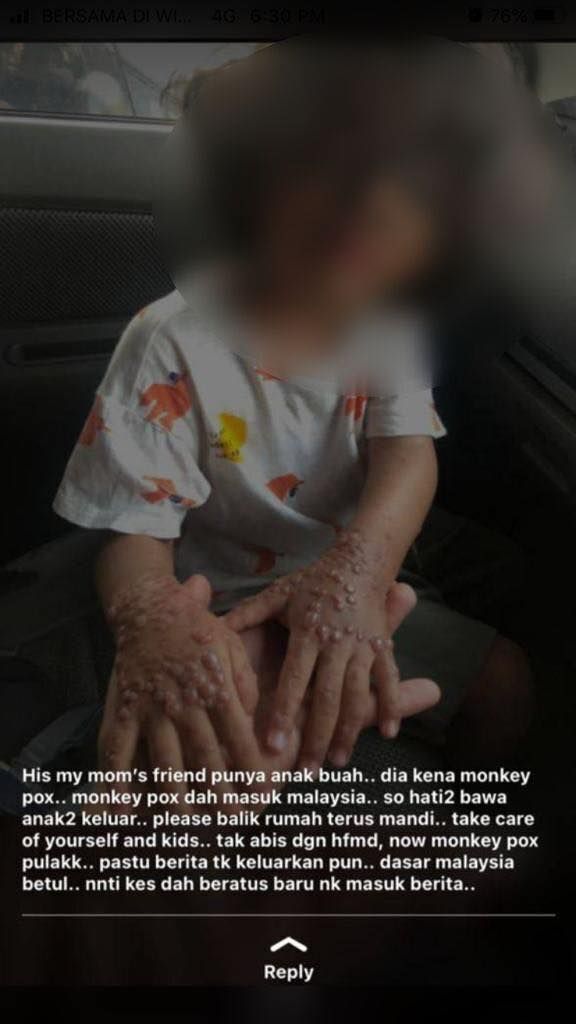 Tiada kes cacar monyet diterima kementerian kesihatan setakat ini