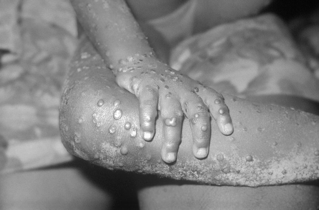 Experts advise monkeypox vaccination before travelling overseas