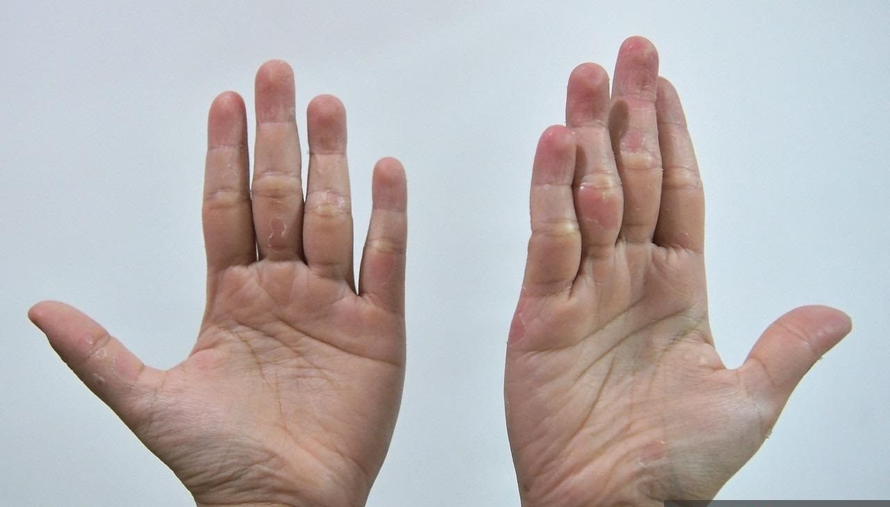 MOH: Use of alternative treatment for HFMD not encouraged