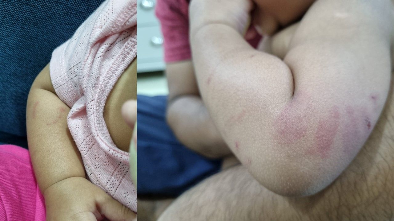 女童托儿所内遭咬伤  警方证实女童母亲报案