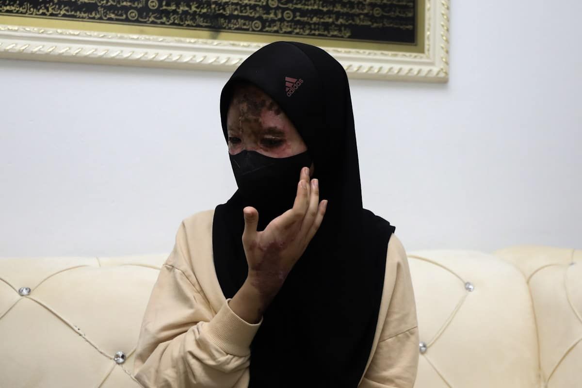 Ibu mangsa simbah asid harap anak jalani pembedahan, kembali hidup normal