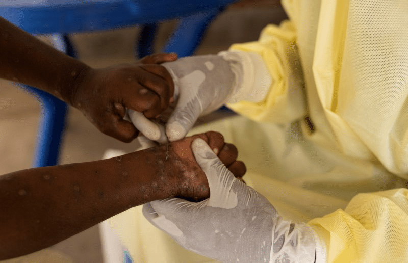 WHO launches global plan to contain mpox outbreaks