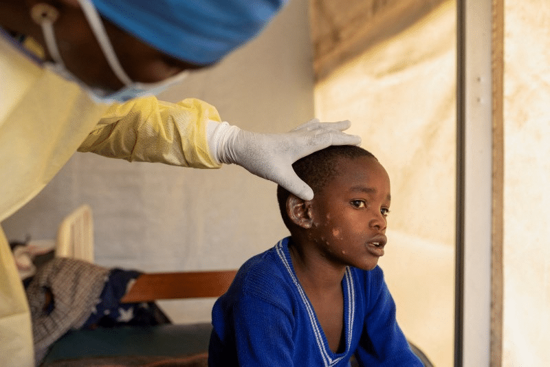 WHO confirms first case of new mpox strain outside Africa as outbreak spreads