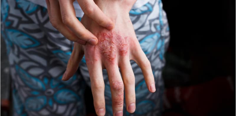 Ekzema: Krim steroid berlebihan boleh cetus ketulan pada badan