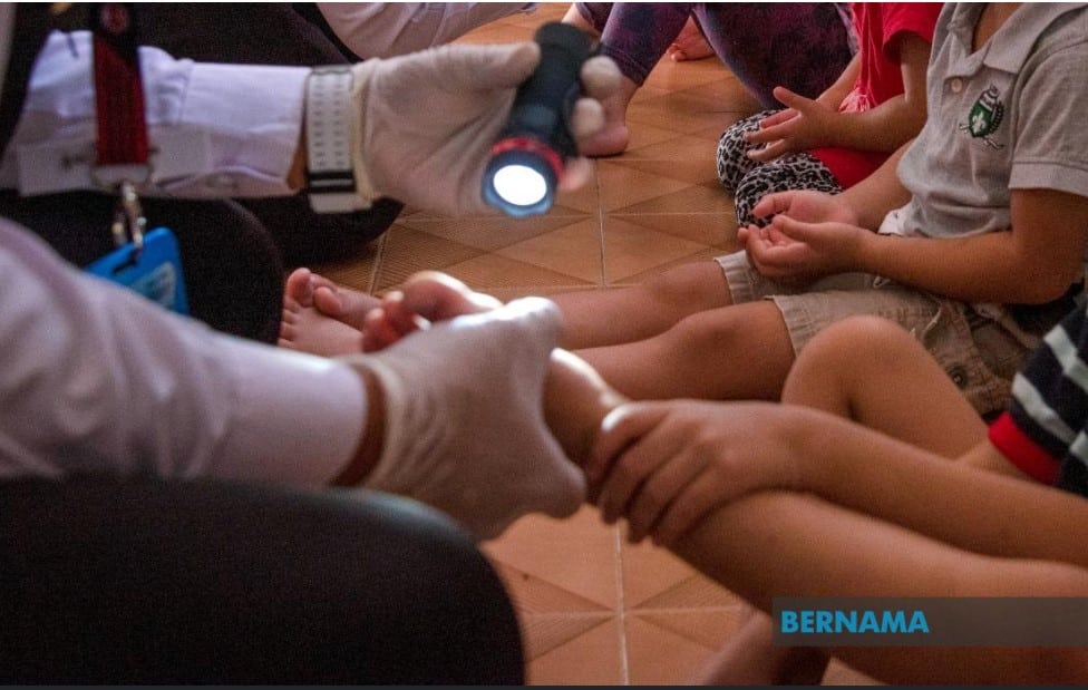 Pakar: Waspada penyakit HFMD ketika musim cuti sekolah