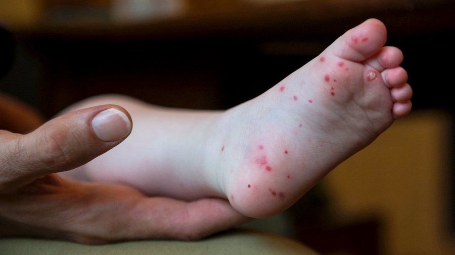 ஏப்ரல் 20-26 வரை நாட்டில்  99,601 கை,கால், வாய்ப் புண் நோய்ச் சம்பவங்கள் பதிவு