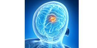 மூளைக்கட்டி நோய் சுமார் 250,000 பேரின் உயிரை பறிக்கிறது