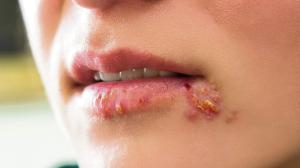 Risiko HIV tiga kali ganda, Herpes serang mulut, alat kelamin