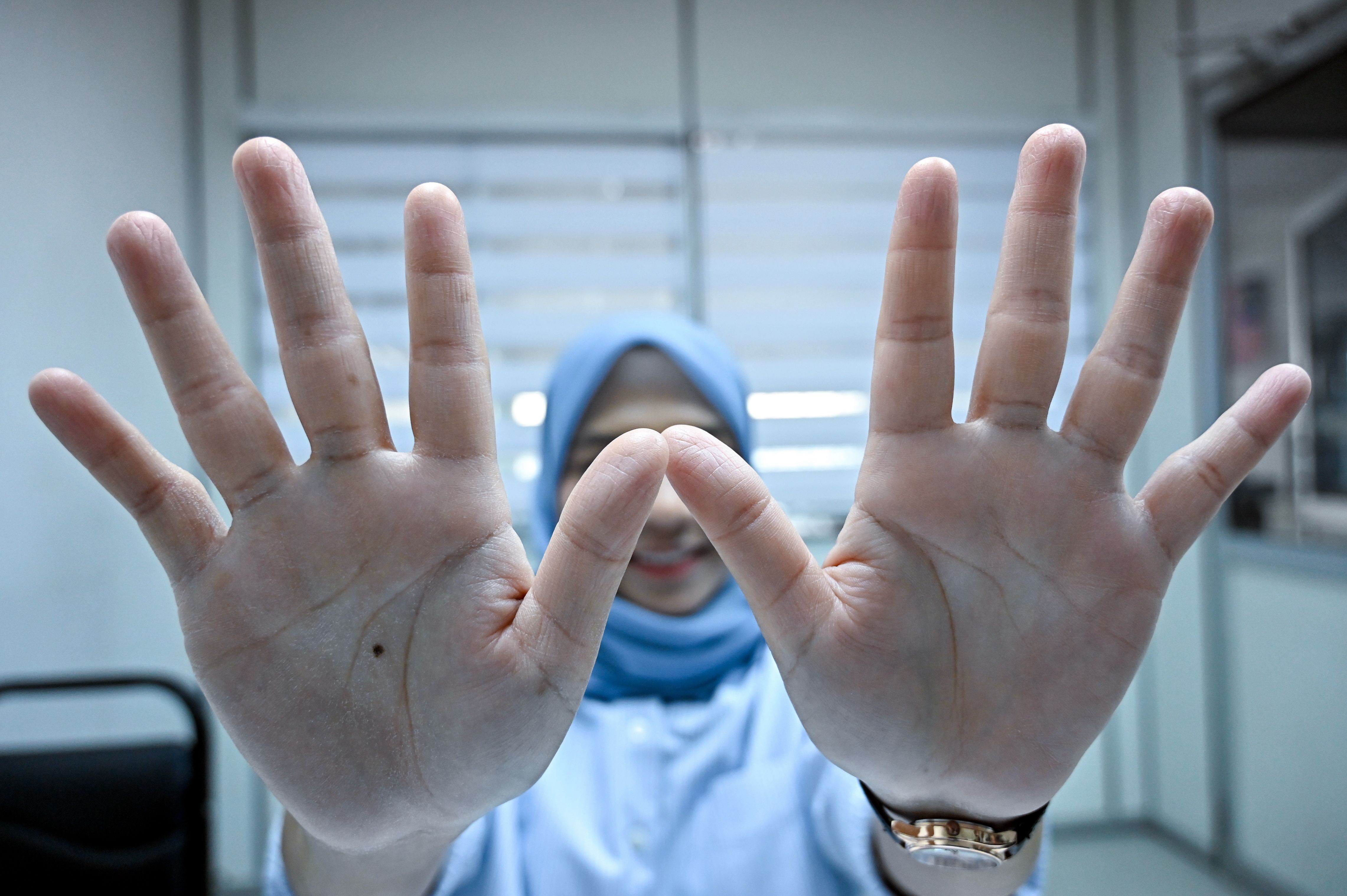 Tiada cap jari akibat penyakit kulit, wanita sukar urus hidup harian