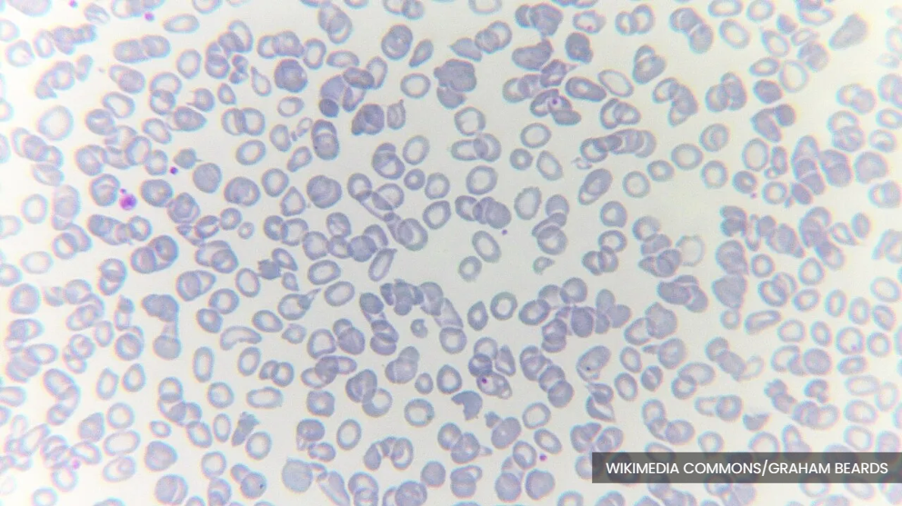 Over 9,500 thalassemia patients treated at RM3m each