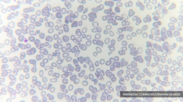 Over 9,500 thalassemia patients treated at RM3m each