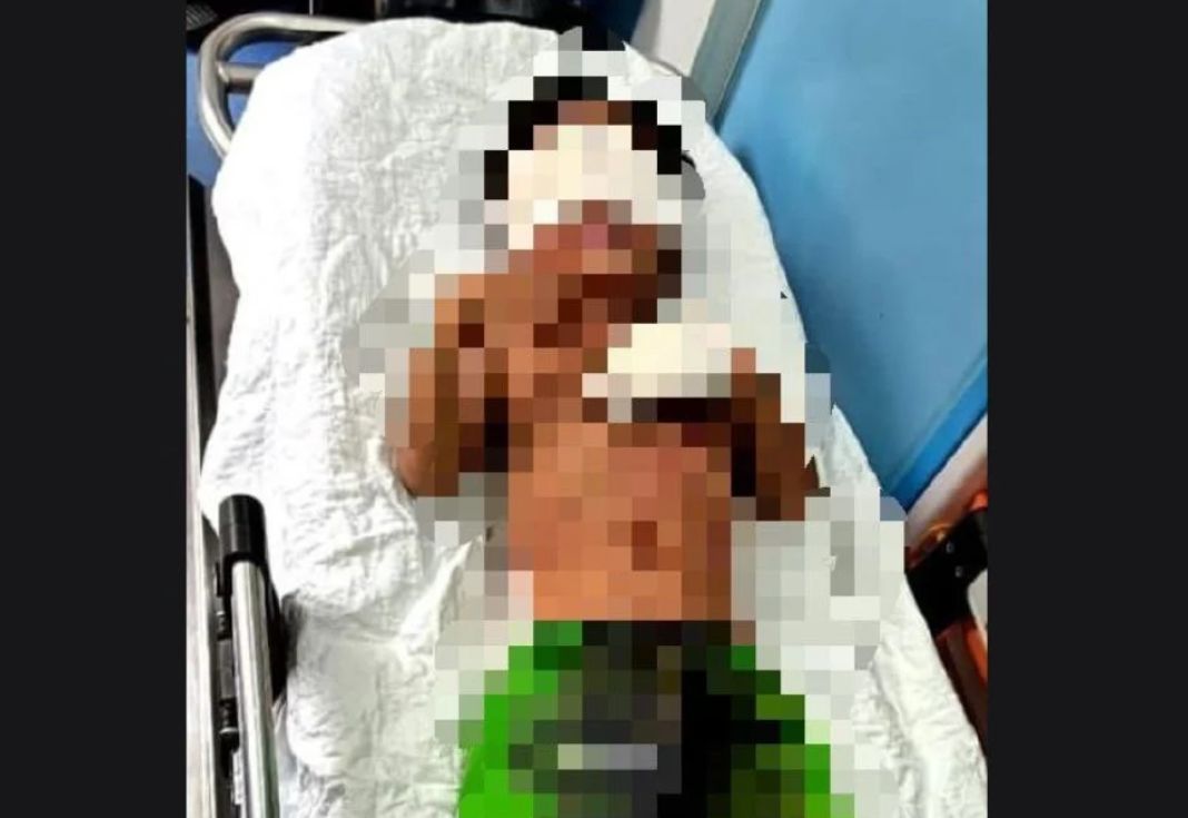 与同伴玩鞭炮突然爆炸 4岁男童手指被炸断