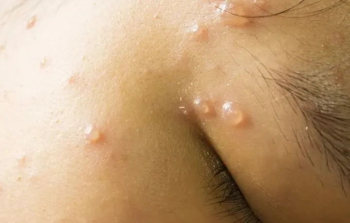 多名学生感染水痘   万津中华小学学前班停课4天