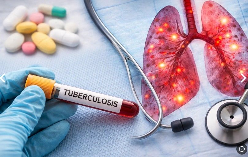 【雪州议会】截至4月录得1222宗肺结核病例   八打灵县居首有321宗