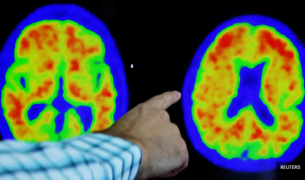 Young people also at risk of developing dementia