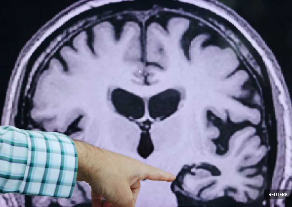 Young people also at risk of developing dementia